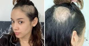 Bea Benedicto gets real about getting 'depressed, anxious and balding'