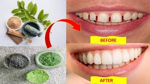 How do veneers fix gap in front teeth? How To Fix Gap Between Teeth Naturally At Home Without Braces Health Pavilion Bright Side Youtube