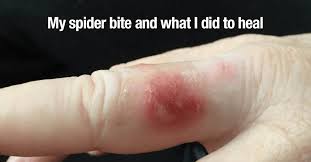 Different types of spider bites may provoke different reactions in different people that hobo spiders, wolf spiders, house spiders, and the bites of other domestic types do not contain venoms that are of. My Spider Bite And What I Did To Heal Everywomanover29