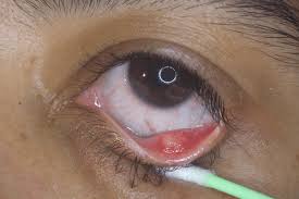 Cara selanjutnya dalam cara menghilangkan cat di baju adalah dengan menggunakan pisau atau sendok. Ubat Ketumbit Mata Bayi