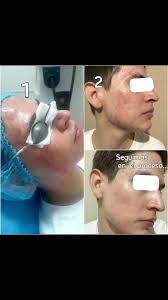 👩🏻‍⚕️ ¿ Quieres tu Piel Bonita para Diciembre ?, Iniciemos tu Proceso de  recuperar su Salud y belleza. El proceso va dando sus resultados con  disciplina y constancia, así que comienza ya., Agenda tu ...