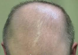 Although the cause of male pattern baldness is not yet fully understood, it does seem to be intimately linked to a compound known as dht, or dihydrotestosterone. Is There A Connection Between Creatine And Dht