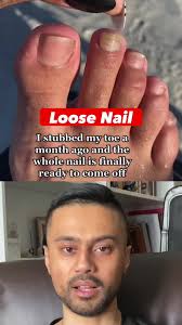 Foot doctor reacts to loose toe nail causes by trauma aka stubbed toe #fyp  #vira #toenail #podiatry #thegoodfootdoctor