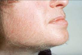 Plus the time and money spent on waxing and shaving to keep skin smooth is seriously daunting. Hirsutism Pcos Facial Hair Female Facial Hair Hair Loss Causes
