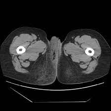 Jul 20, 2021 · introduction. Fournier Gangrene Radiology Reference Article Radiopaedia Org