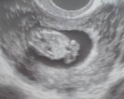 Die untersuchung ergibt keine diagnose, sondern ermittelt lediglich eine wahrscheinlichkeit, nach der das risiko einer chromosomenstörung berechnet wird. Geschlecht Schon In 13 Ssw Erkannt Was Meint Ihr Marz 2014 Babyclub Seite 10 Babycenter