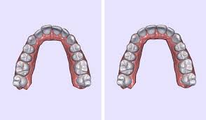 This will only take a few minutes to complete. Smiledirectclub Review What It Was Like To Get My Teeth Straightened