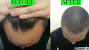Finasteride Breast