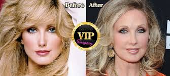 Before and after embalming photos. Morgan Fairchild Plastic Surgery Before And After Photos Morgan Fairchild Plastic Surgery Morgan