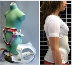 هل الحزام يعالج التقوس نهائيًا؟