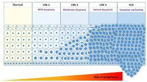 Moderate dysplasia, or cin 2, has a higher and more widely disbursed amount of immature cells. Cervical Pre Cancer And Cancer Progression Cin1 Cervical Download Scientific Diagram