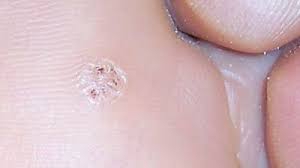 Image result for genital warts