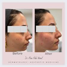 Cheeks and jawline enhancement using HA fillers. @nouvelageclinics