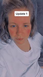 #vsd #6monthsold #stahm #rubymemorialhospital #midline