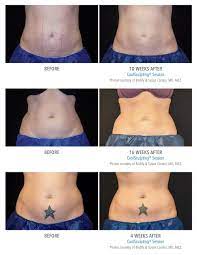 Pin On Coolsculpting