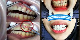 Gigi tak rata tapi putih. Bahaya Fake Veneer