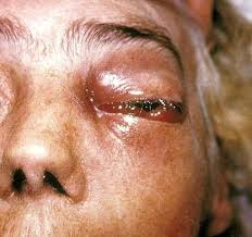 Jun 04, 2021 · la société d'infectiologie chilienne a annoncé dimanche un cas de mucormycose, ou champignon noir, lié à la covid sur son territoire. Une Infection Grave De Champignon Noir Apparue Chez Des Patients Malades De La Covid 19 En Inde