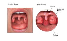Image result for Strep throat infection roof of mouth