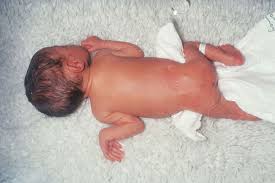 Fetal Alcohol Spectrum Disorders Clinical Advisor