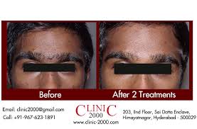 Tweezing works on any facial hair. How To Remove Hair From Eyebrows Permanently Eyebrowshaper