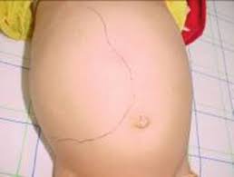 Image result for Nephroblastoma