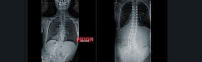 Current recommendation is to include entire kyphotic cobb angle and stop distally to include the first stable. Excessive Kyphosis Neurosurgery
