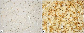 Professionally installed recessed lighting adds a touch of sophistication to any room, and the led bulbs used in modern systems can last for decades. Frontiers Aberrant Expression Of High Mobility Group Box Protein 1 In The Idiopathic Inflammatory Myopathies Cell And Developmental Biology