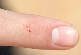 Spider Bites That Look Like Mosquito Bites Bad Bugs Identify Bug Bites From Mosquitos Spiders And More Spider Bites Home Health Remedies Home Remedies For Spiders