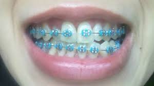 For All Your Character Needs Follow Characentral Braces Colors Dental Braces Braces Teeth Colors