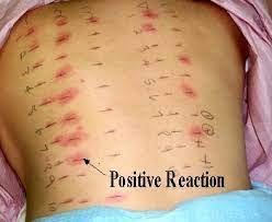 Allergy Skin Tests Definition Purpose Procedure Results Medicalook Tests