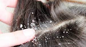 Il est possible de faire ce gommage en complément des soins. Gommage Du Cuir Chevelu Pourquoi Utiliser Un Exfoliant Capillaire