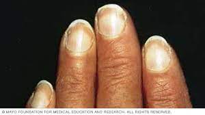 The chronic renal insufficiency cohort (cric) study. Slide Show 7 Fingernail Problems Not To Ignore Mayo Clinic