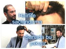 Protez Sac Hakkinda Tum Merak Edilenler Bu Baslikta Bursa Ha