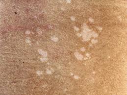 Pin On Skin Issues