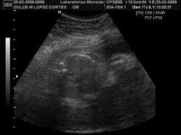 Ultrasonido Bebé Dulce