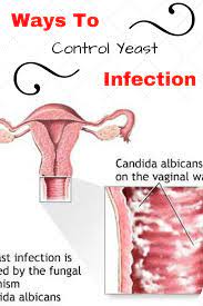 You Aren T Simply Restricted To An Antifungal Lotion When It Comes To Treating Yeast Infection Yeast Infection Relief Yeast Infection Yeast Infection Treatment