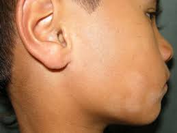 The individual hypopigmented patches in. Pityriasis Alba Symptome Therapie Online Hautarzt Appdoc