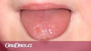 Image result for Puchýře na jazyku