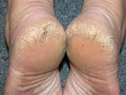 Cracked Heel Dermnet Nz