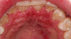 Image result for Erythroplakia roof of mouth