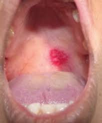 Image result for Physical injury red spots roof of mouth