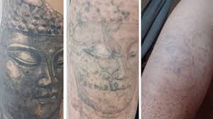 Nalini prasad the 1st medical spa in roseville serving roseville, sacramento, granite bay, rocklin, lincoln, Have You Considered Laser Tattoo Removal Accidental Hipster Mum