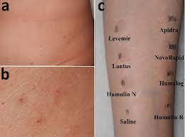 Maybe you would like to learn more about one of these? A There Were Itchy Erythemas Of Various Sizes At The Insulin Injection Download Scientific Diagram