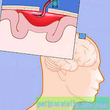 Hematom Intracranian Cauze Diagnostic Tratament È™i ConsecinÈ›e Boli È™i CondiÈ›ii 2021