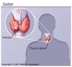 Image result for Goiter