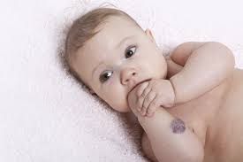 Image result for baby birthmarks
