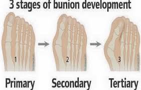 Image result for BUNIONS in shoes