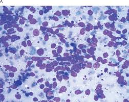 The clinical and morphological picture of merkel cell carcinoma (mcc) may be rather challenging; Differential Diagnosis Of Metastatic Tumors Chapter 6 Silverberg S Principles And Practice Of Surgical Pathology And Cytopathology