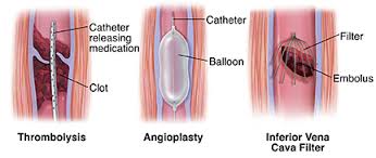 Deep vein thrombosis (dvt) and acute pulmonary embolism (pe) are two manifestations of venous thromboembolism (vte). Procedures For Deep Vein Thrombosis