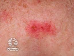 Image result for infected tick bite